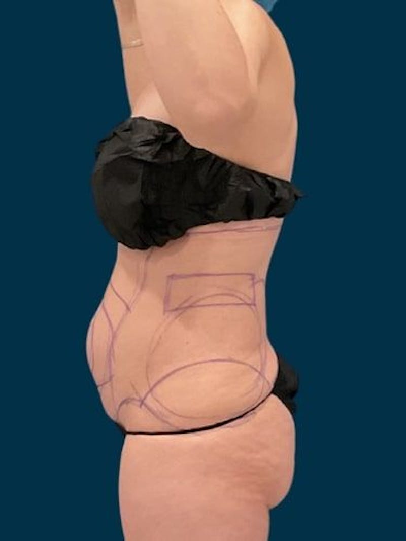 Liposuction Before & After Gallery - Patient 340947 - Image 3