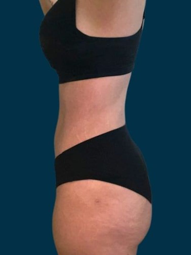 Liposuction Before & After Gallery - Patient 340947 - Image 4