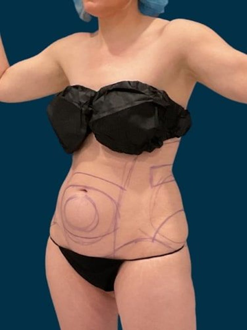 Liposuction Before & After Gallery - Patient 340947 - Image 5