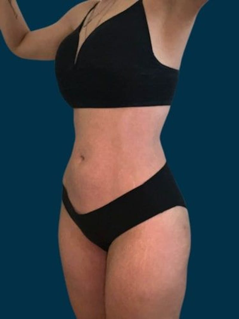 Liposuction Before & After Gallery - Patient 340947 - Image 6