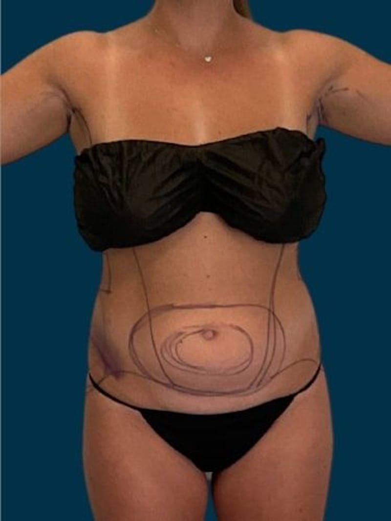 Liposuction Before & After Gallery - Patient 225986 - Image 1