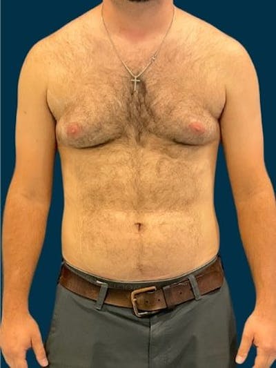 Liposuction Before & After Gallery - Patient 179035 - Image 1