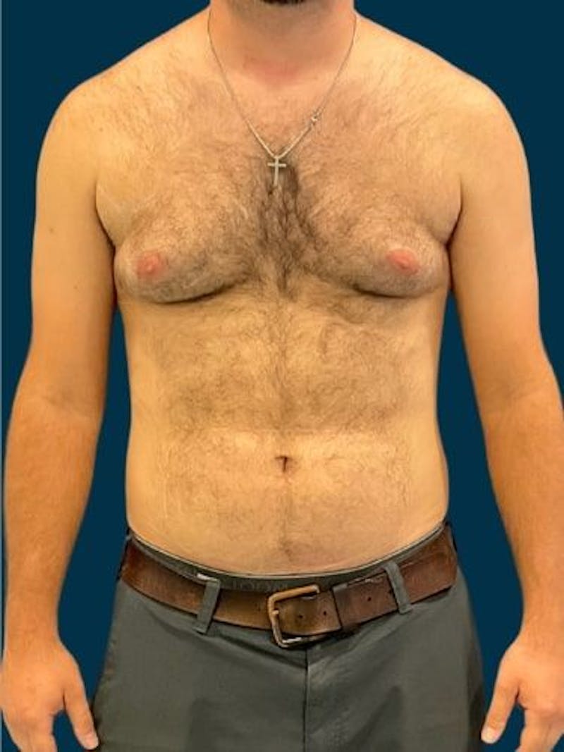 Liposuction Before & After Gallery - Patient 179035 - Image 1