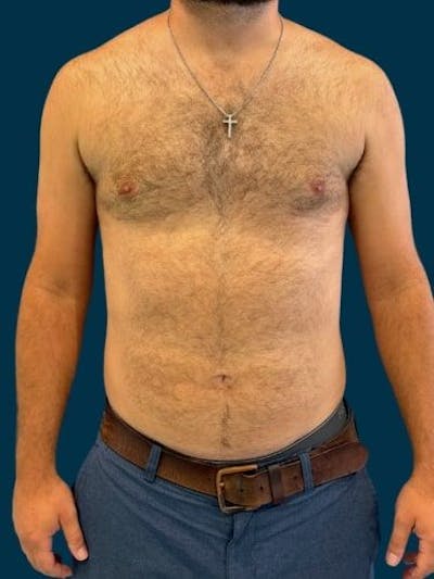 Liposuction Before & After Gallery - Patient 179035 - Image 2