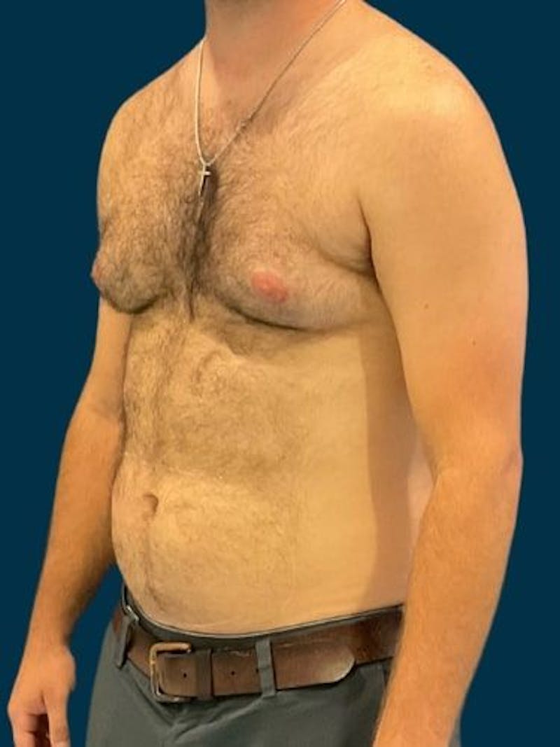 Liposuction Before & After Gallery - Patient 179035 - Image 3