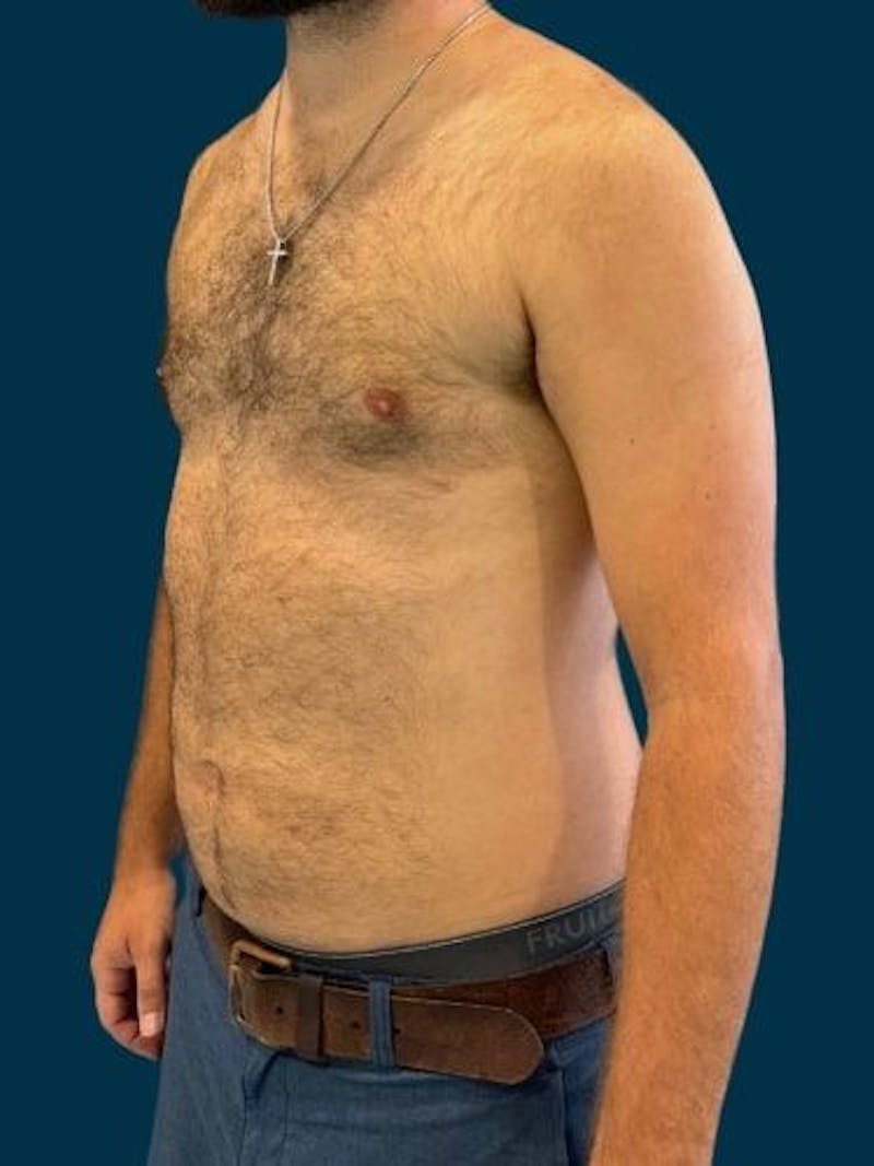 Liposuction Before & After Gallery - Patient 179035 - Image 4