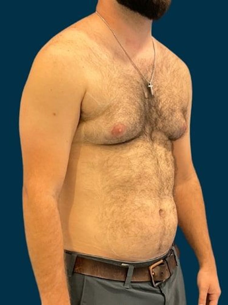 Liposuction Before & After Gallery - Patient 179035 - Image 5