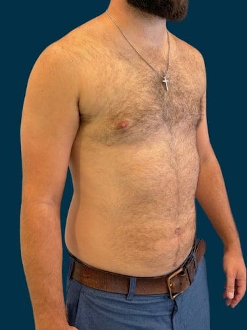 Liposuction Before & After Gallery - Patient 179035 - Image 6