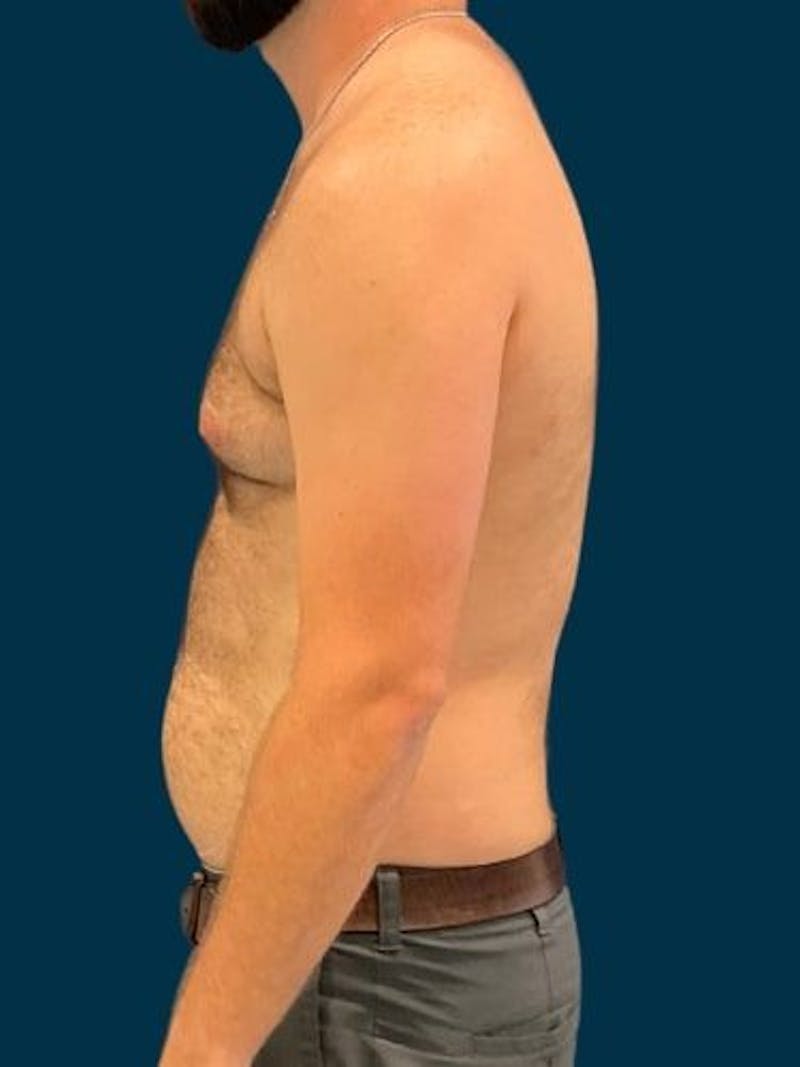 Liposuction Before & After Gallery - Patient 179035 - Image 7