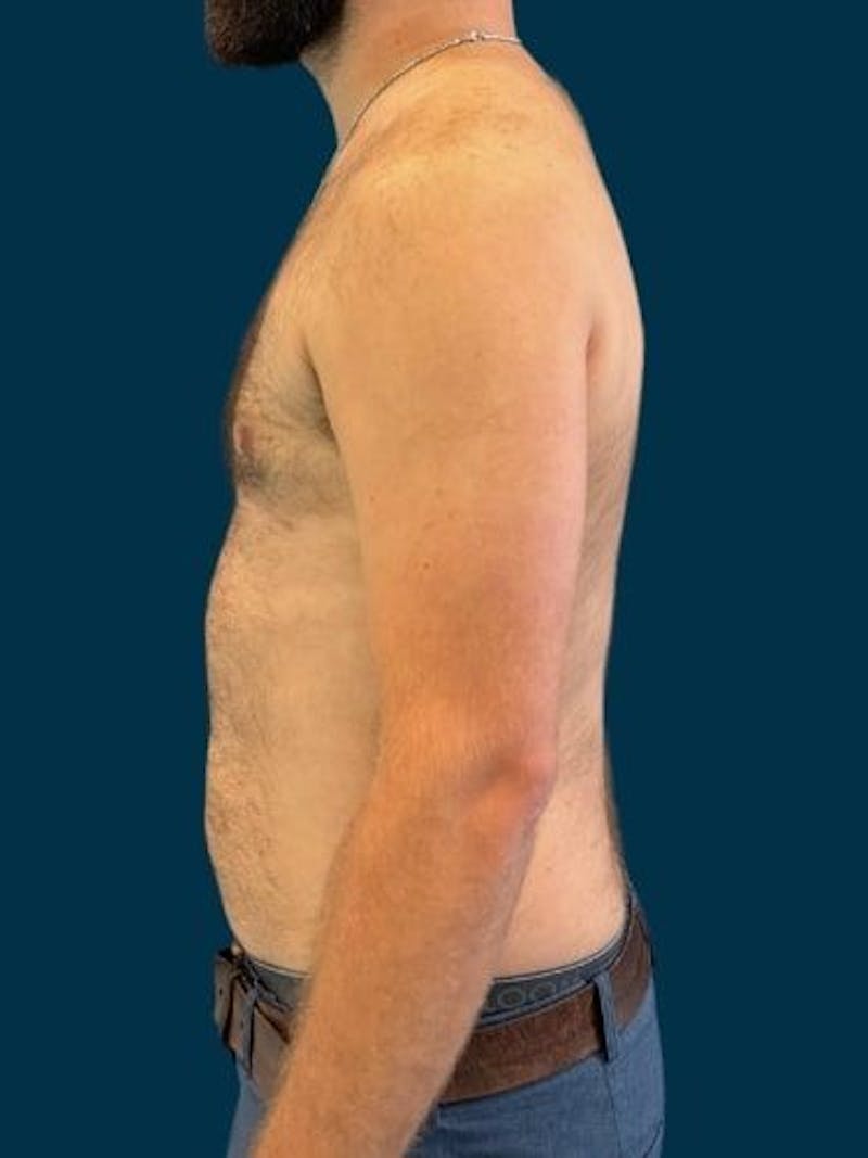 Liposuction Before & After Gallery - Patient 179035 - Image 8