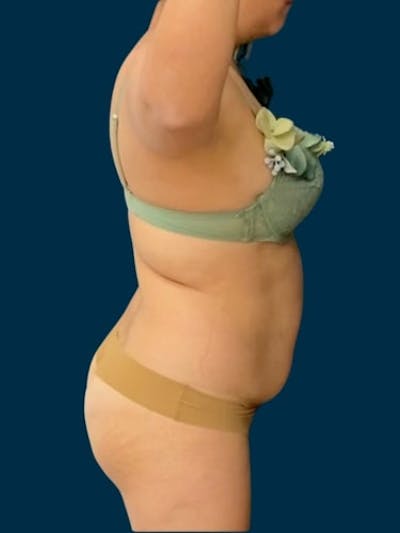 Liposuction Before & After Gallery - Patient 608773 - Image 1