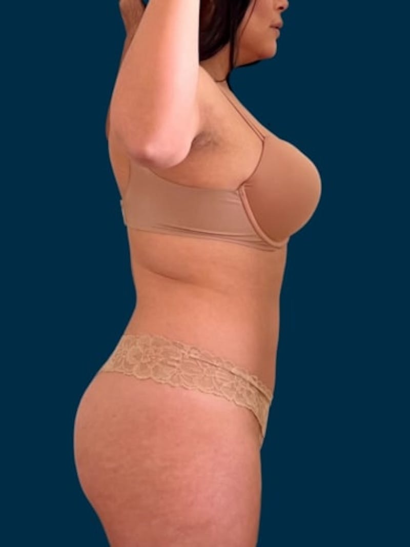 Liposuction Before & After Gallery - Patient 608773 - Image 2