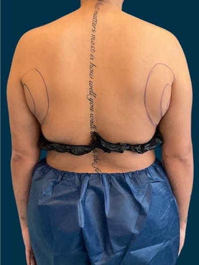 Liposuction Before & After Gallery - Patient 181266 - Image 1
