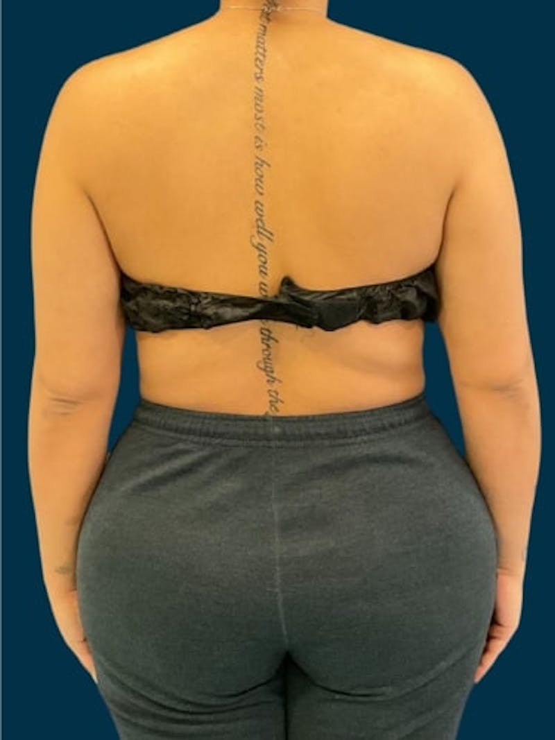 Liposuction Before & After Gallery - Patient 181266 - Image 2