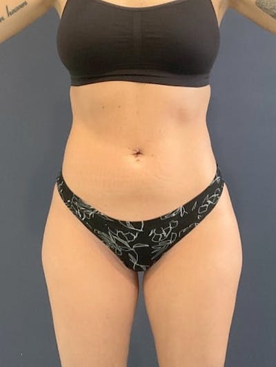 Liposuction Before & After Gallery - Patient 198657 - Image 2