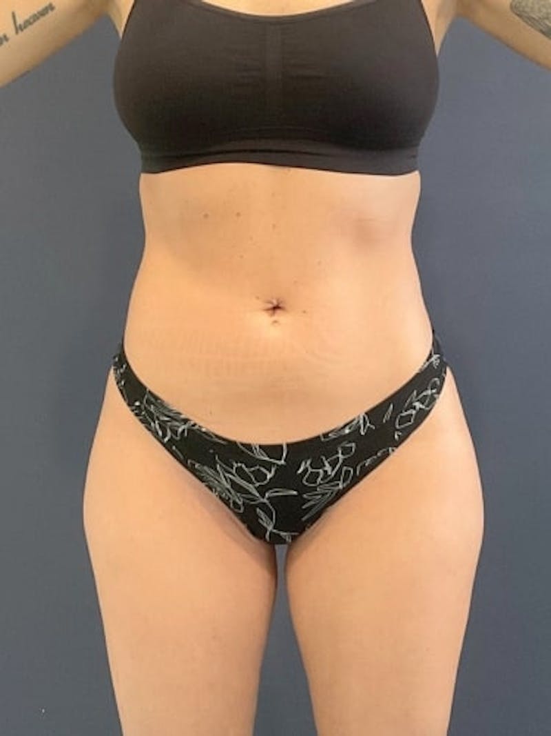 Liposuction Before & After Gallery - Patient 198657 - Image 2