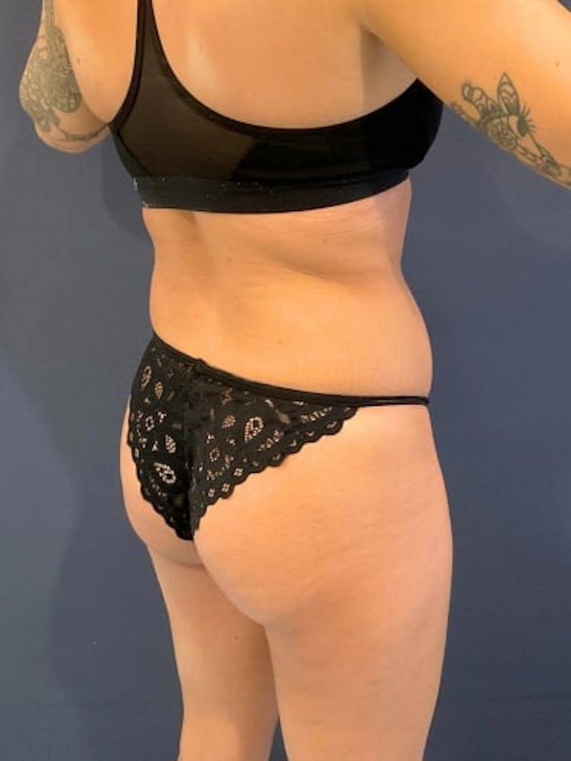 Liposuction Before & After Gallery - Patient 198657 - Image 3