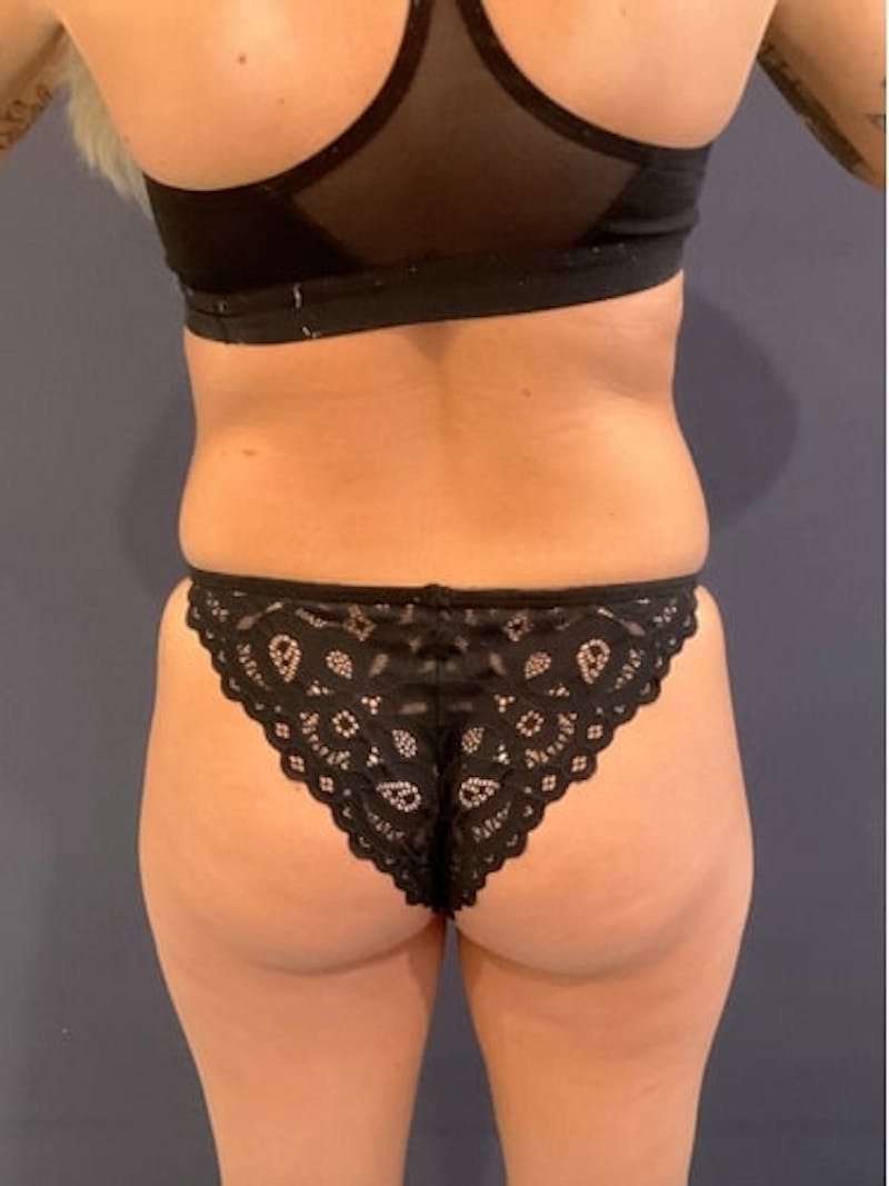 Liposuction Before & After Gallery - Patient 198657 - Image 5