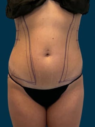 Liposuction Before & After Gallery - Patient 338612 - Image 1