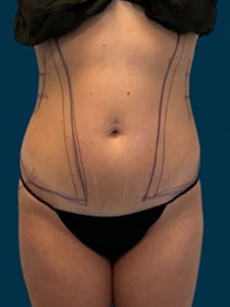 Liposuction Before & After Gallery - Patient 338612 - Image 1