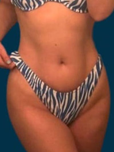 Liposuction Before & After Gallery - Patient 338612 - Image 2