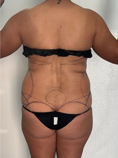 Liposuction Before & After Gallery - Patient 259013 - Image 1