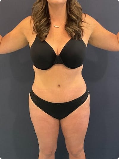 Liposuction Before & After Gallery - Patient 257791 - Image 1