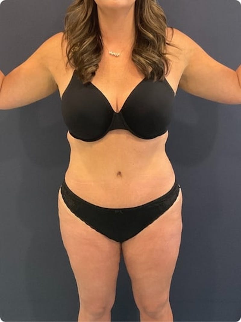 Liposuction Before & After Gallery - Patient 257791 - Image 1
