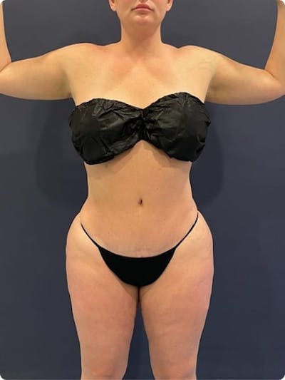 Liposuction Before & After Gallery - Patient 257791 - Image 2