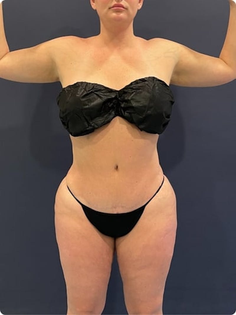 Liposuction Before & After Gallery - Patient 257791 - Image 2