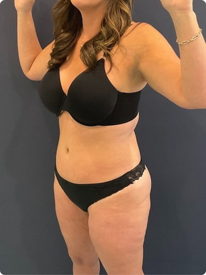 Liposuction Before & After Gallery - Patient 257791 - Image 3