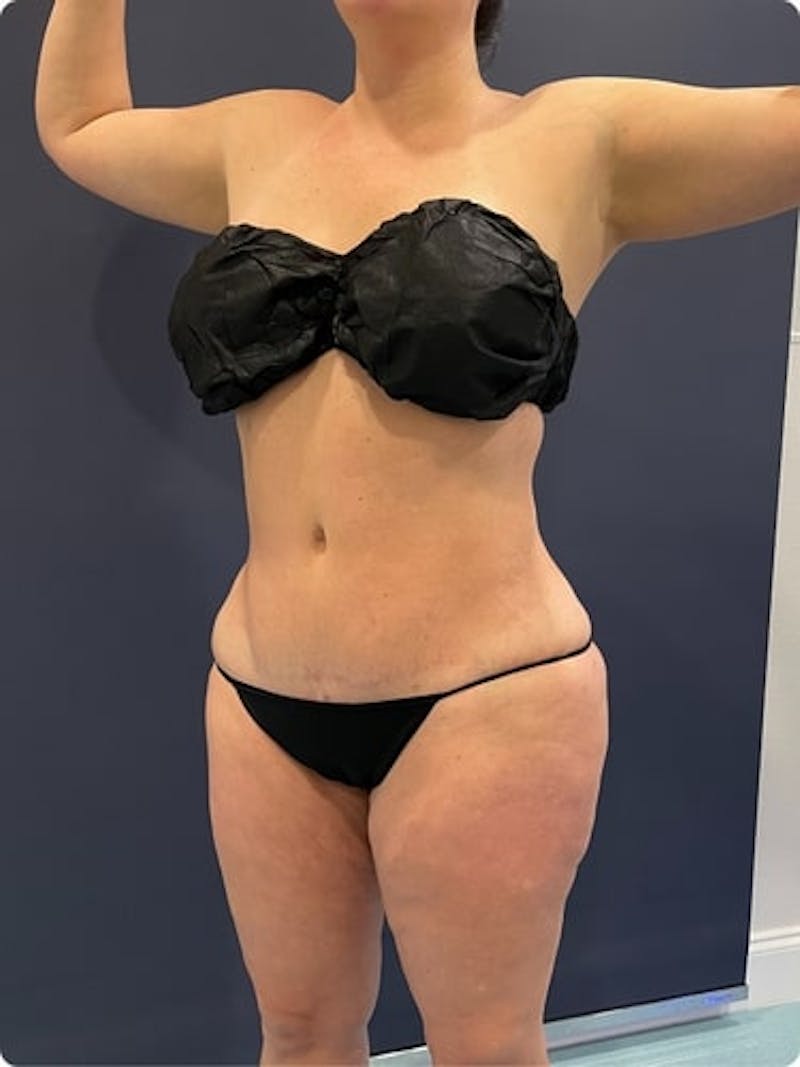 Liposuction Before & After Gallery - Patient 257791 - Image 4