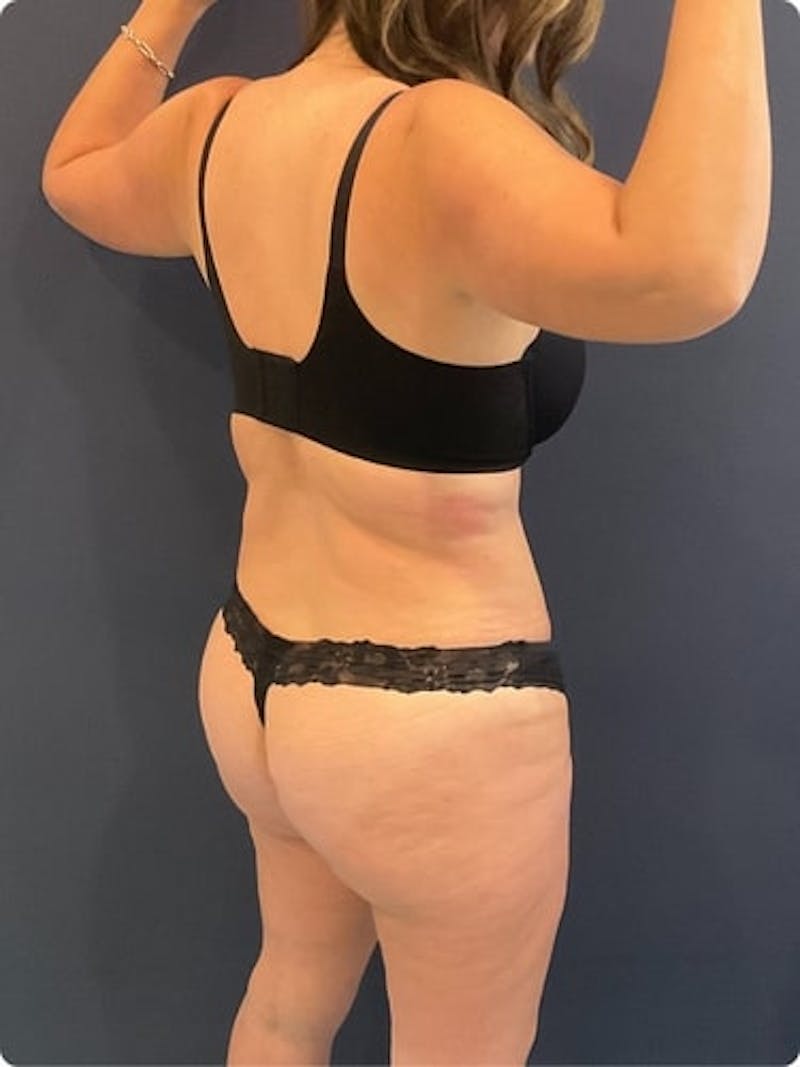 Liposuction Before & After Gallery - Patient 257791 - Image 5