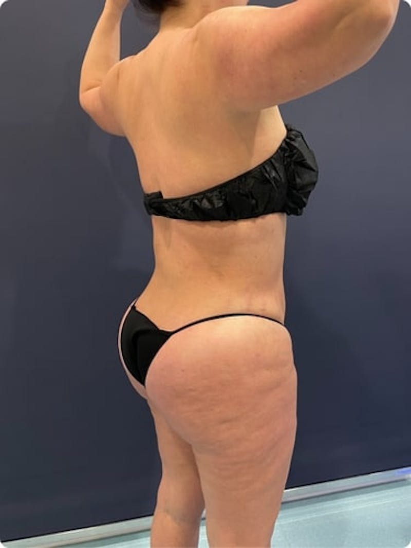 Liposuction Before & After Gallery - Patient 257791 - Image 6