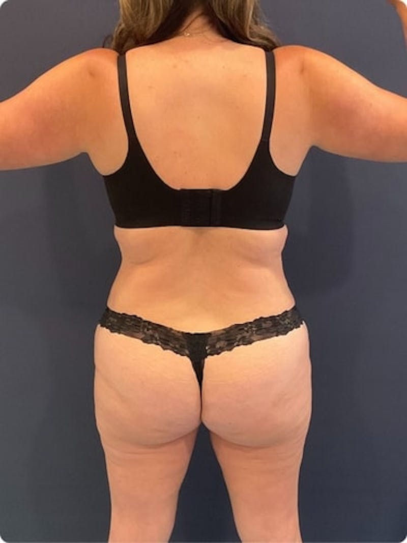 Liposuction Before & After Gallery - Patient 257791 - Image 7