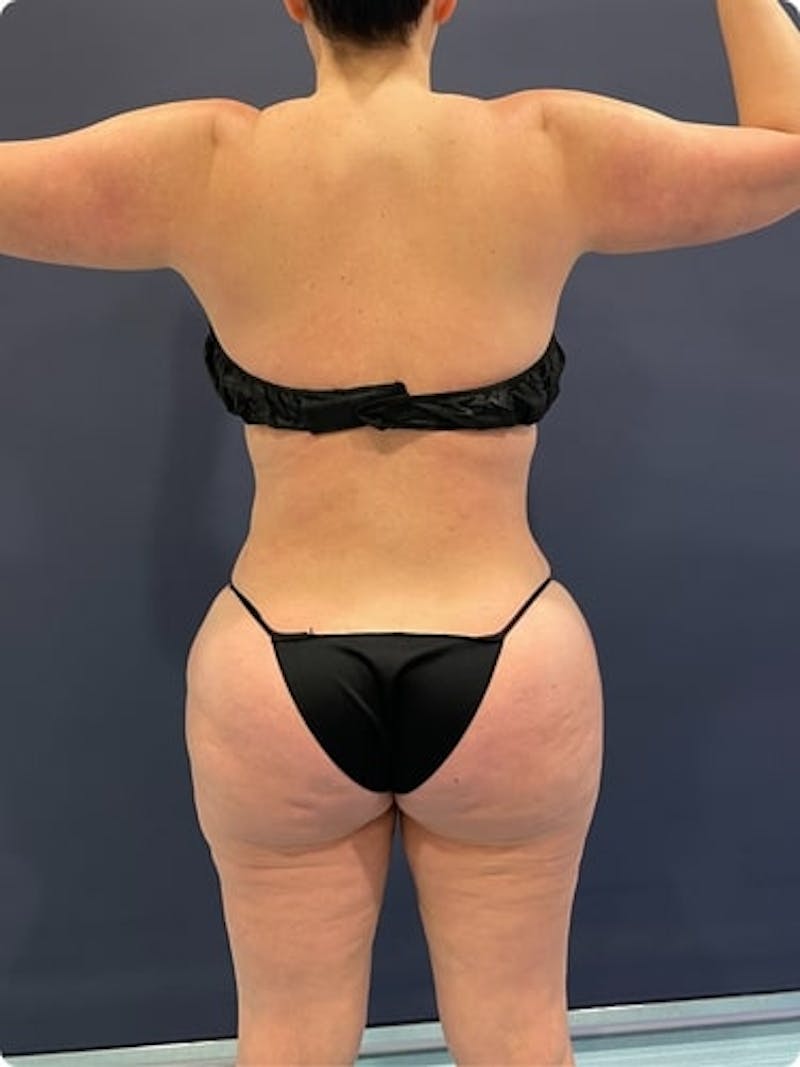 Liposuction Before & After Gallery - Patient 257791 - Image 8