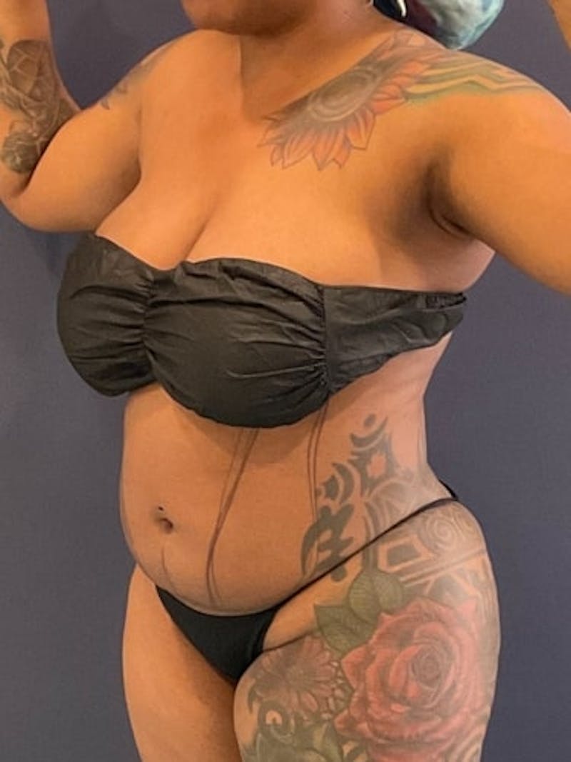 Liposuction Before & After Gallery - Patient 118878 - Image 1