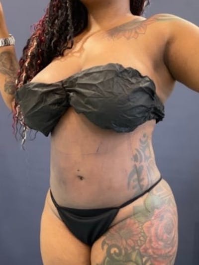 Liposuction Before & After Gallery - Patient 118878 - Image 2
