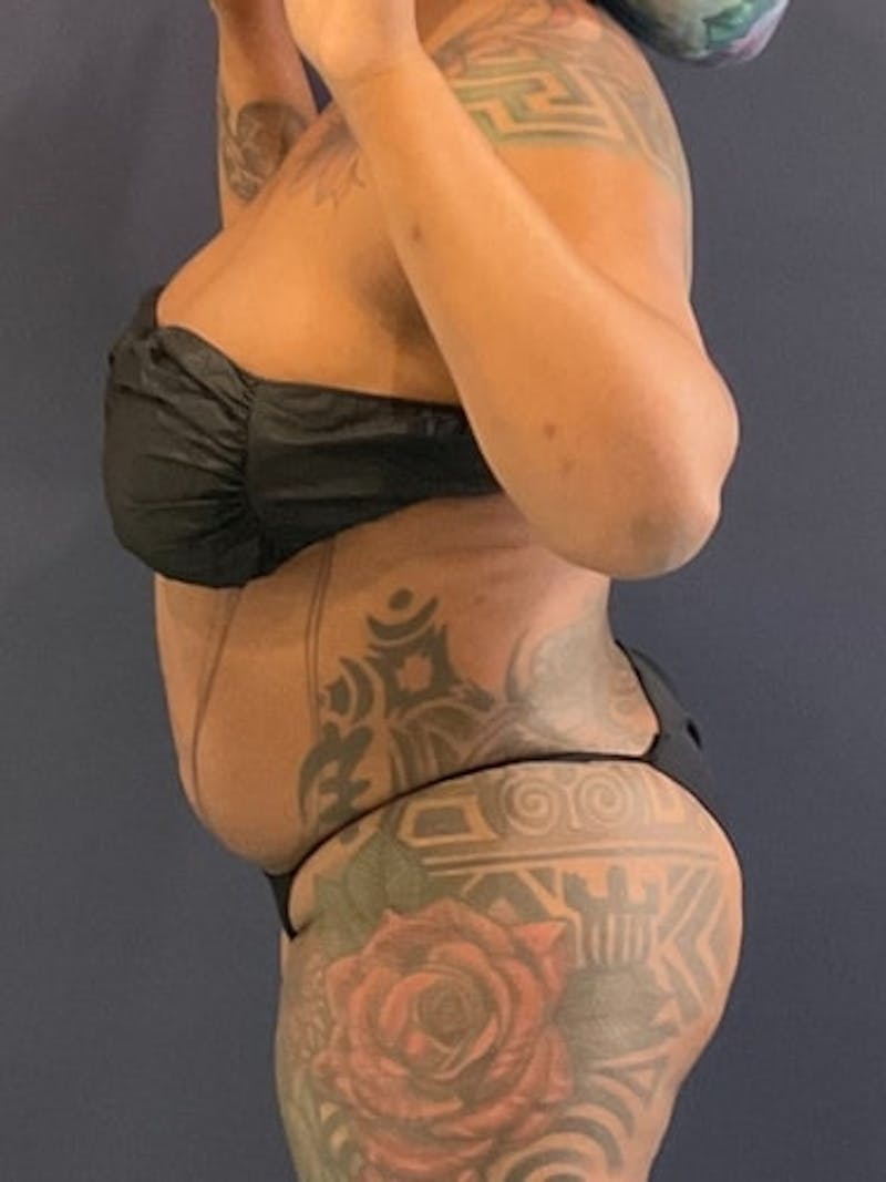 Liposuction Before & After Gallery - Patient 118878 - Image 3