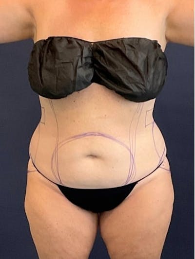 Liposuction Before & After Gallery - Patient 638234 - Image 1