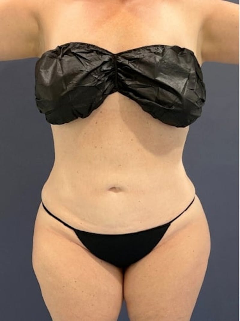Liposuction Before & After Gallery - Patient 638234 - Image 2