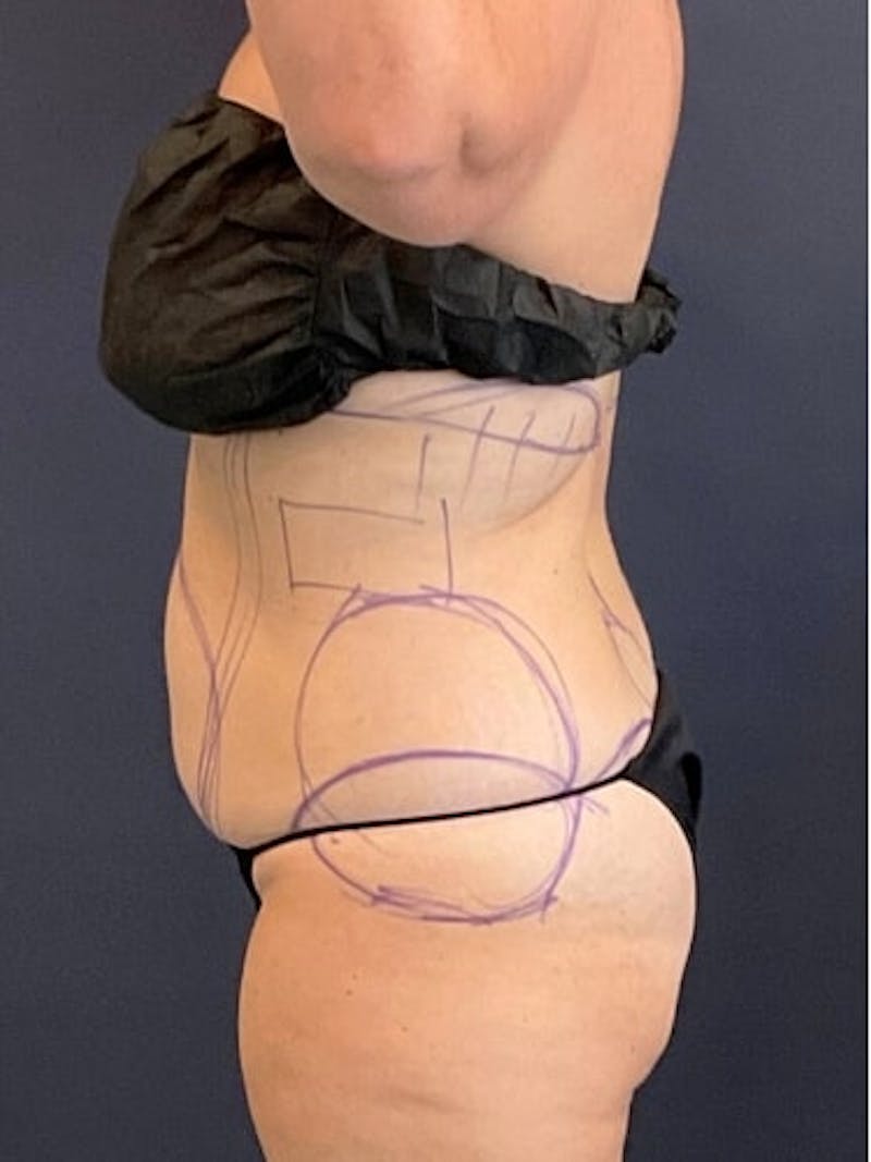 Liposuction Before & After Gallery - Patient 638234 - Image 3