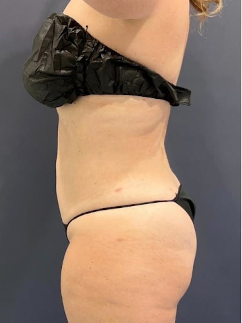 Liposuction Before & After Gallery - Patient 638234 - Image 4
