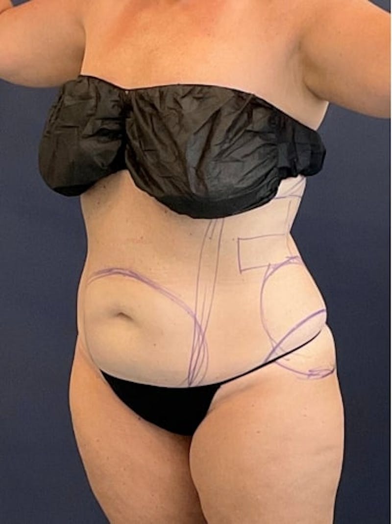 Liposuction Before & After Gallery - Patient 638234 - Image 5