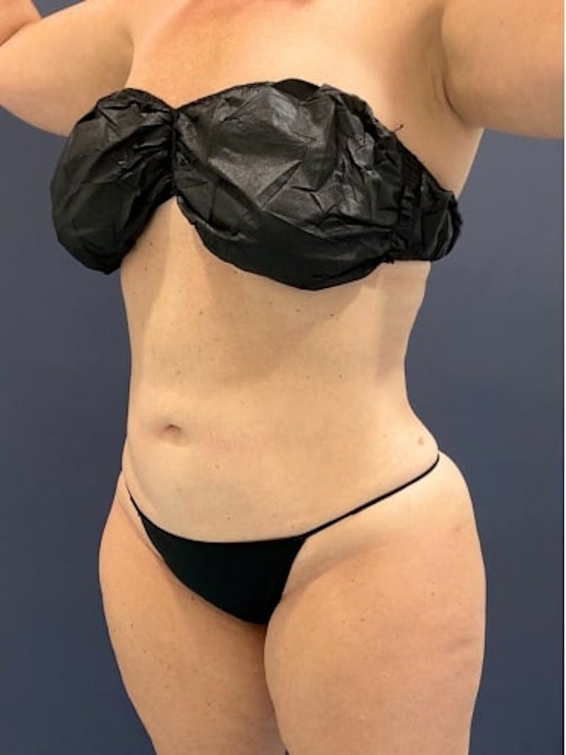 Liposuction Before & After Gallery - Patient 638234 - Image 6