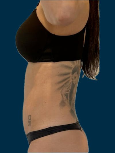 Liposuction Before & After Gallery - Patient 311080 - Image 2