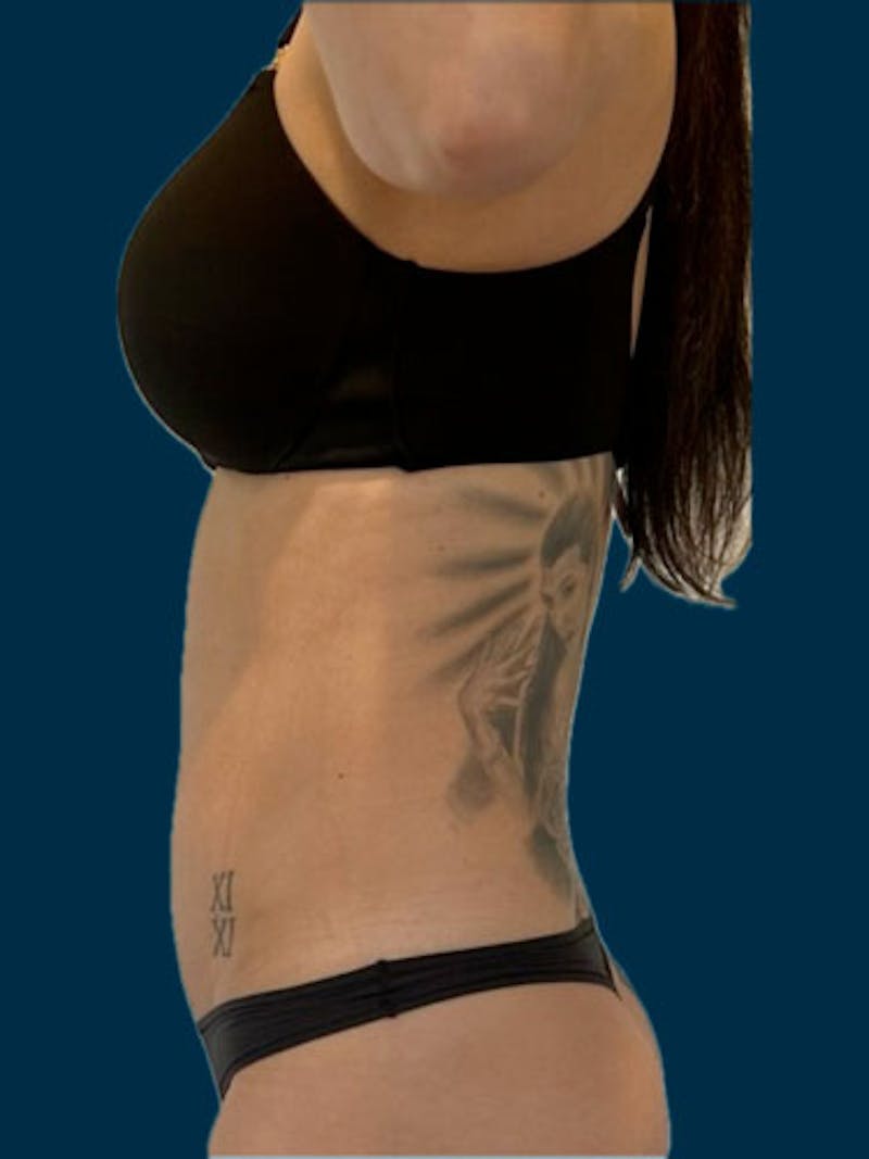 Liposuction Before & After Gallery - Patient 311080 - Image 2