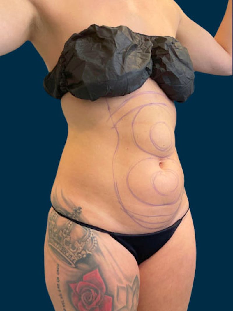 Liposuction Before & After Gallery - Patient 311080 - Image 3