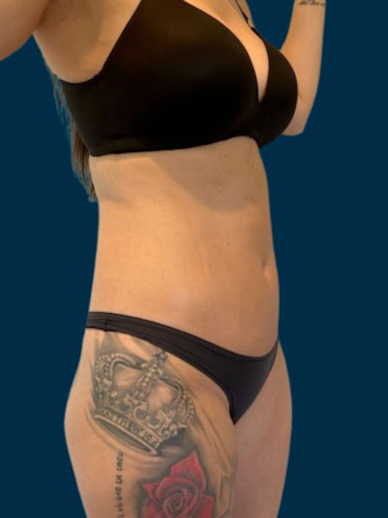 Liposuction Before & After Gallery - Patient 311080 - Image 4