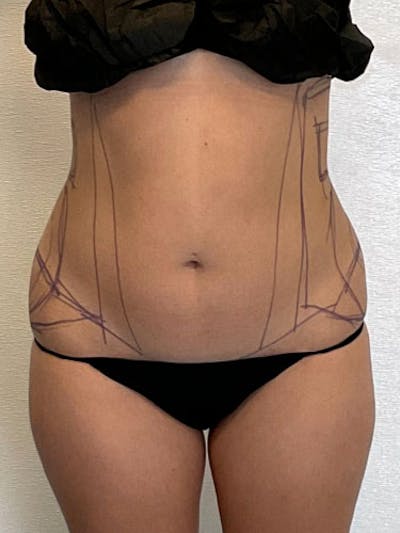 Liposuction Before & After Gallery - Patient 315029 - Image 1